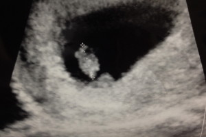 baby-ultrasound-8-weeks